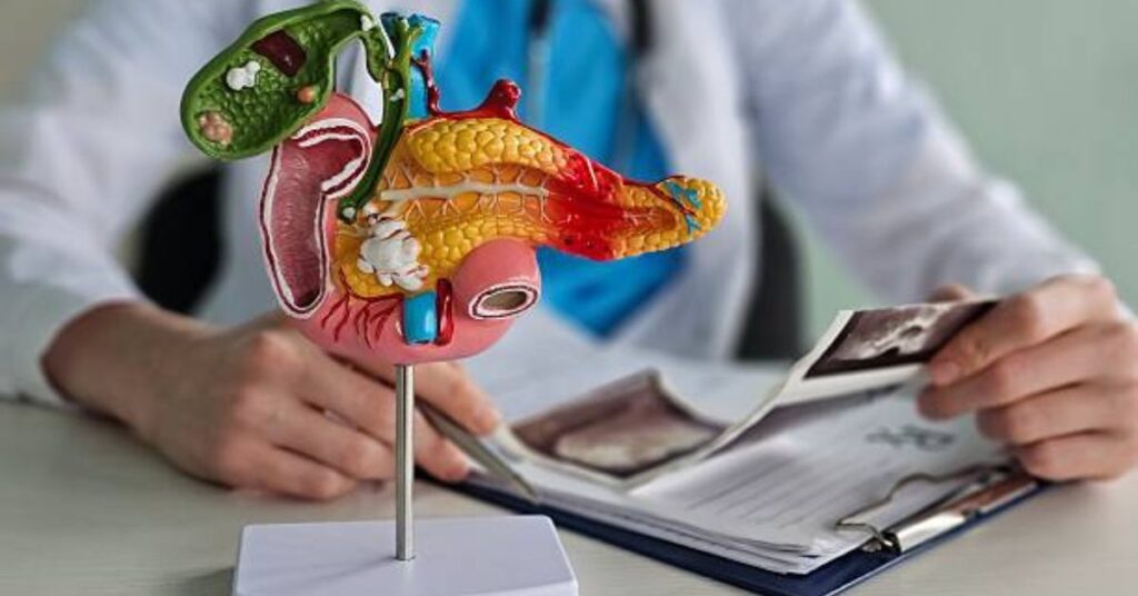 How to Diagnose Pancreatic Cancer Early